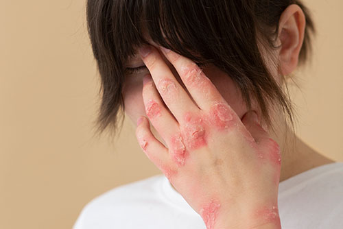 Curso de Psicodermatología